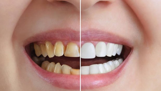 How Cosmetic Dentistry Can Boost Your Confidence